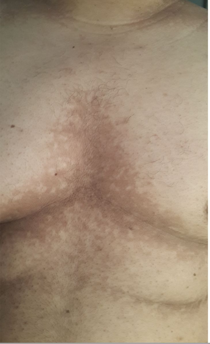 PAPILOMATOSIS RETICULADA