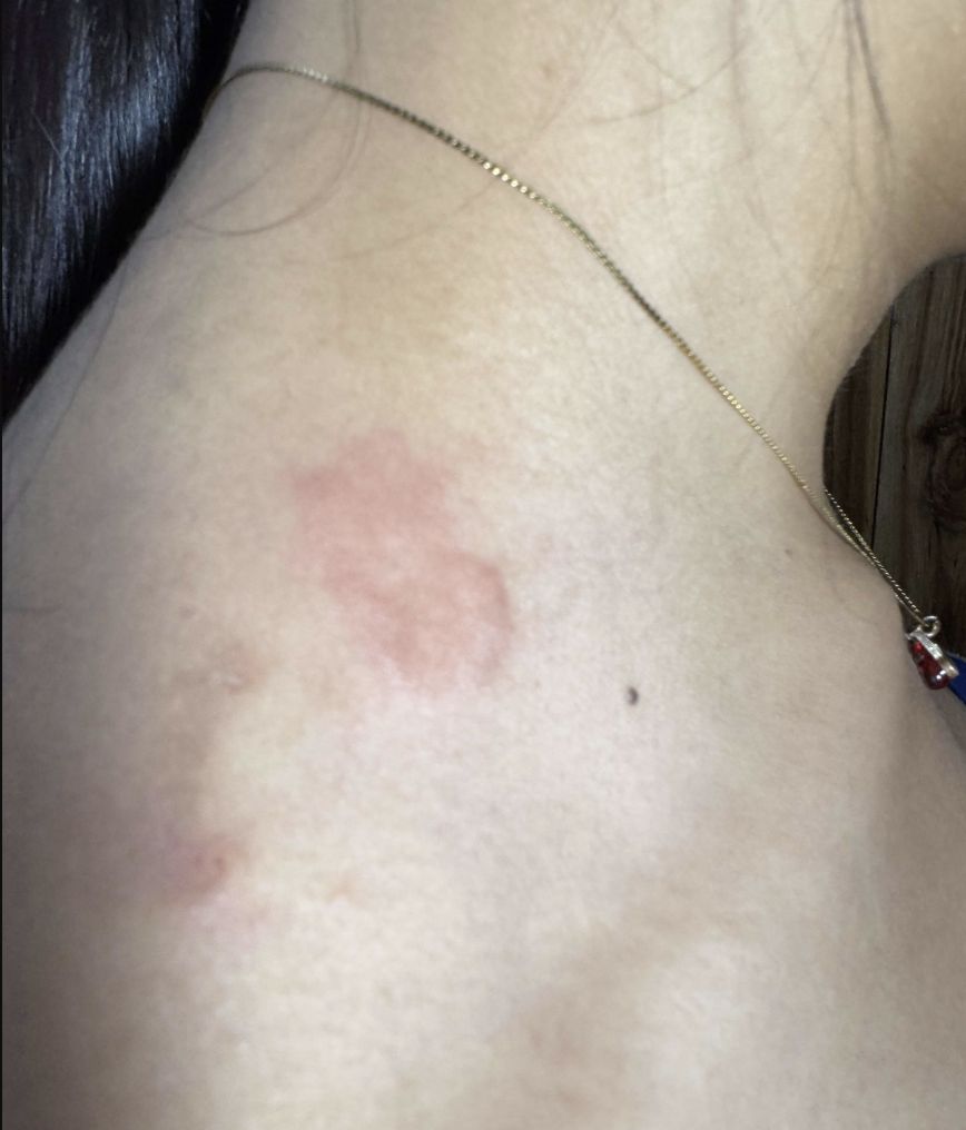 PAPILOMATOSIS RETICULADA
