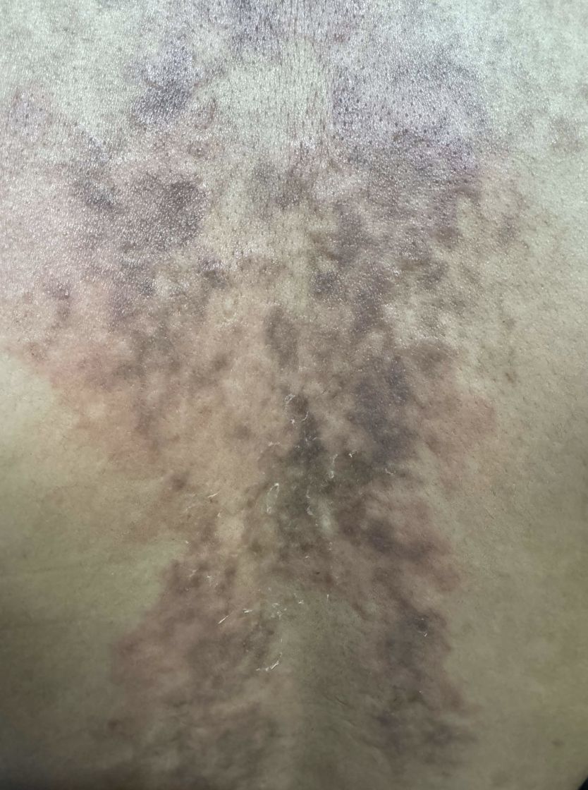 PAPILOMATOSIS RETICULADA