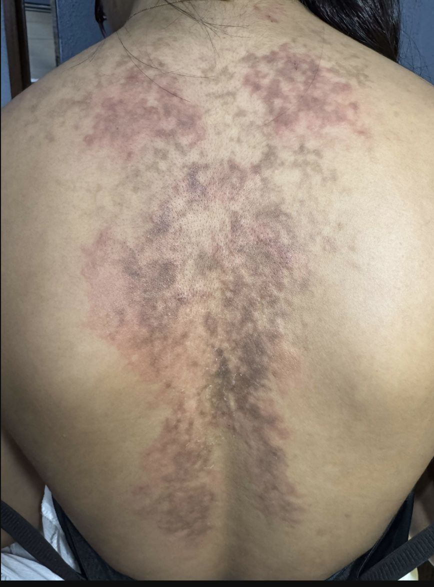 PAPILOMATOSIS RETICULADA