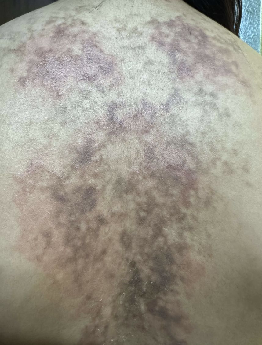 PAPILOMATOSIS RETICULADA