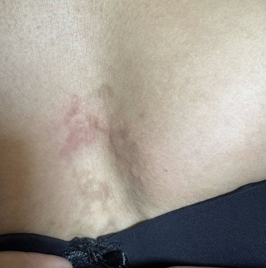 PAPILOMATOSIS RETICULADA