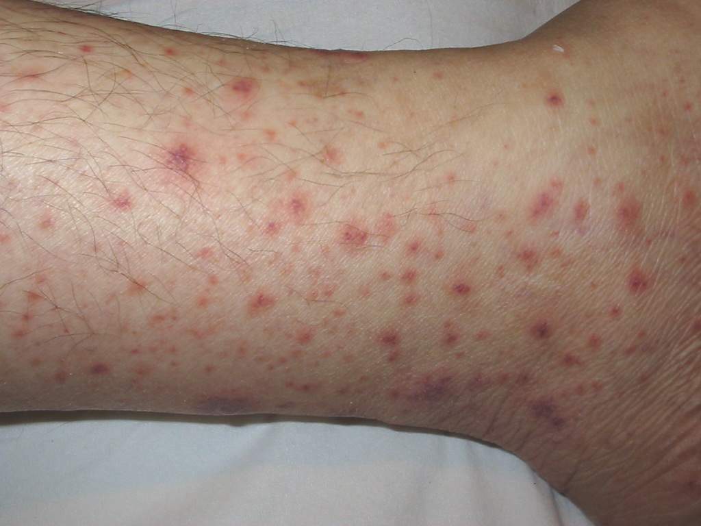 VASCULITIS Leucocitoplástica