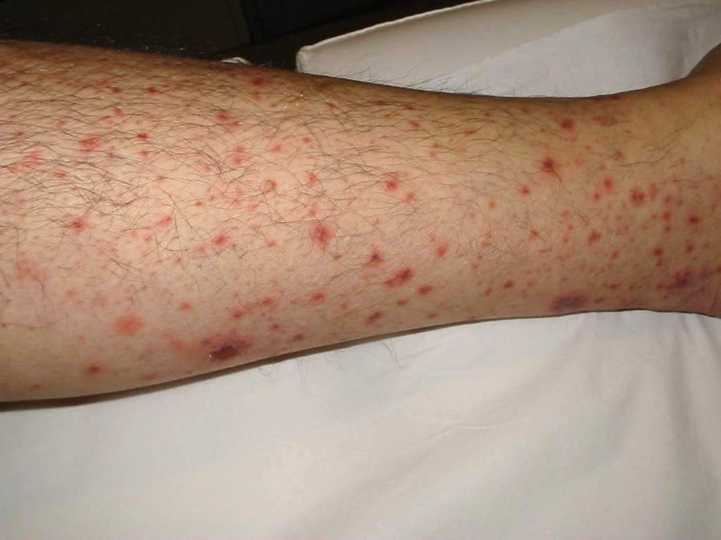 VASCULITIS Leucocitoplástica