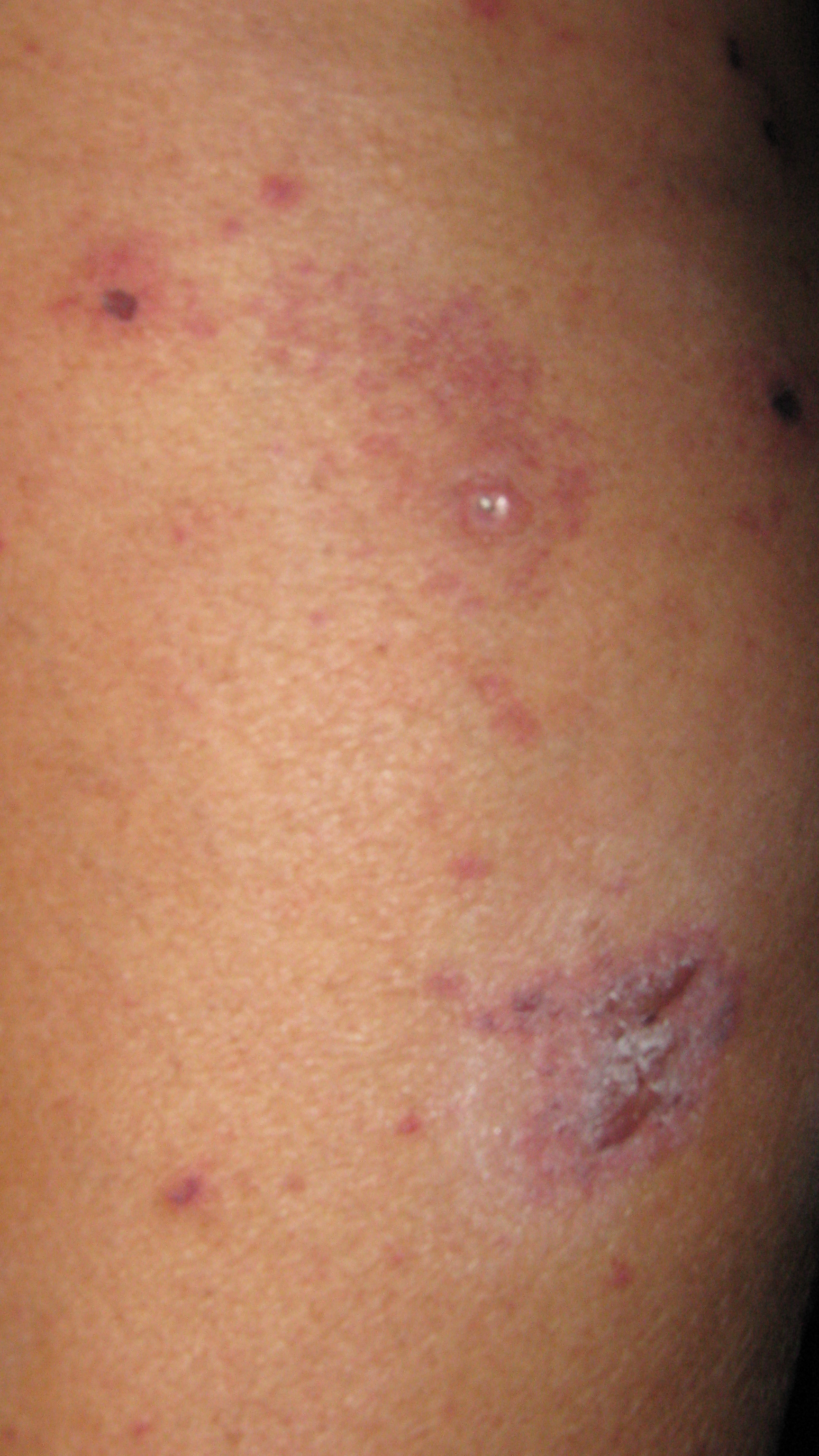 VASCULITIS Leucocitoplástica
