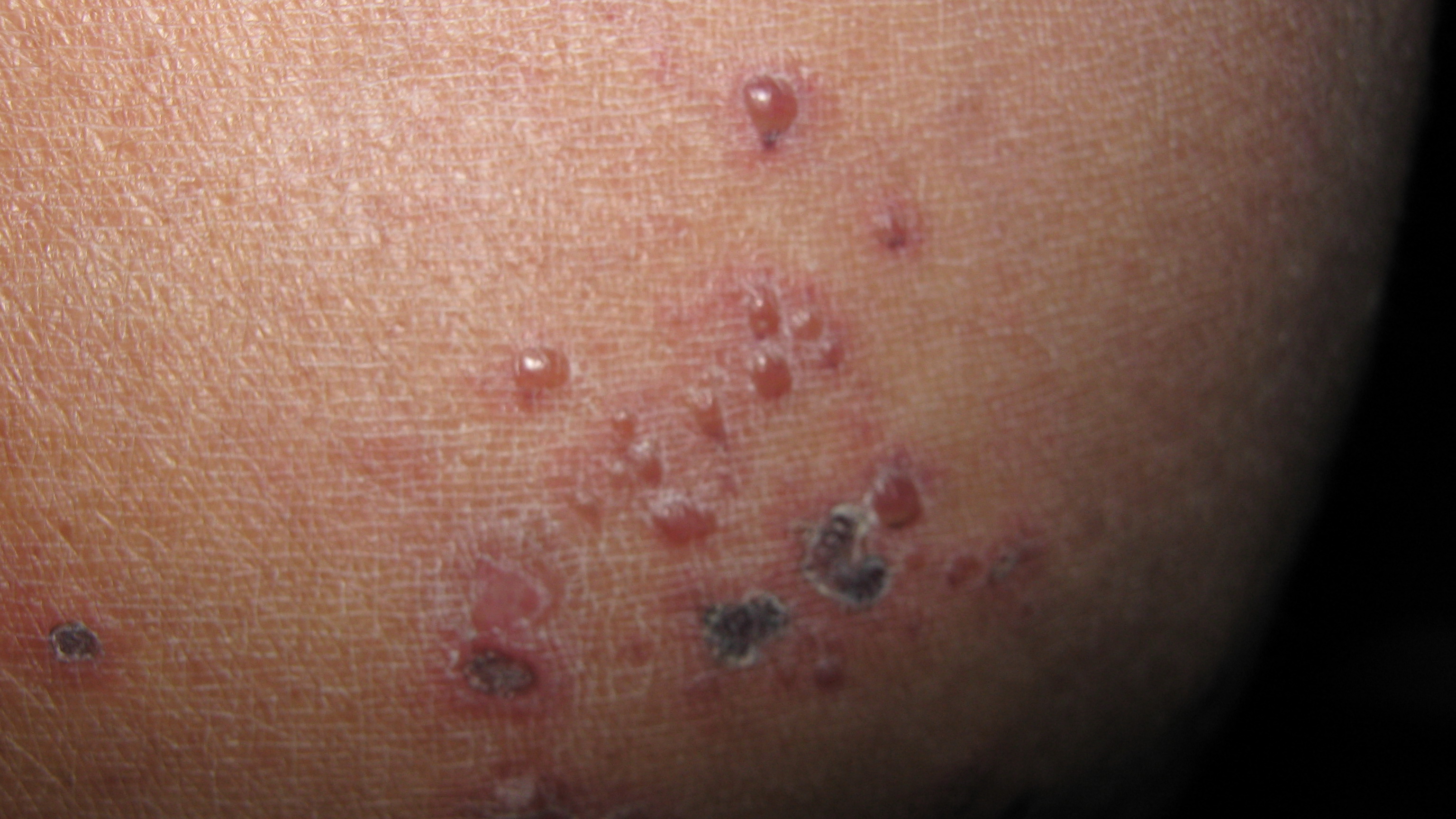 VASCULITIS Leucocitoplástica