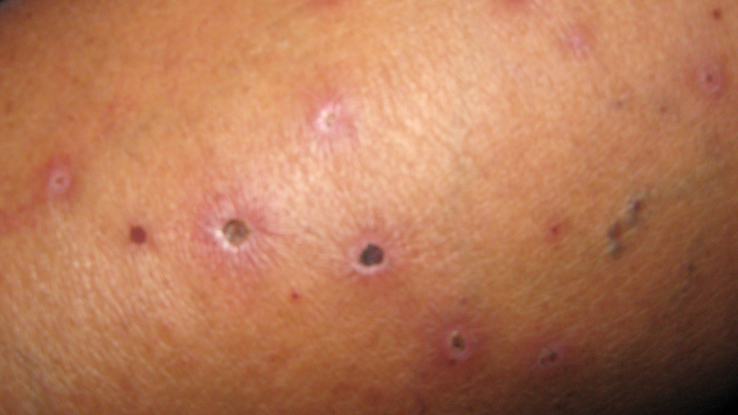 VASCULITIS Leucocitoplástica