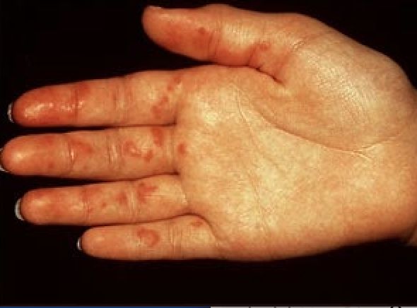 VASCULITIS Lupica