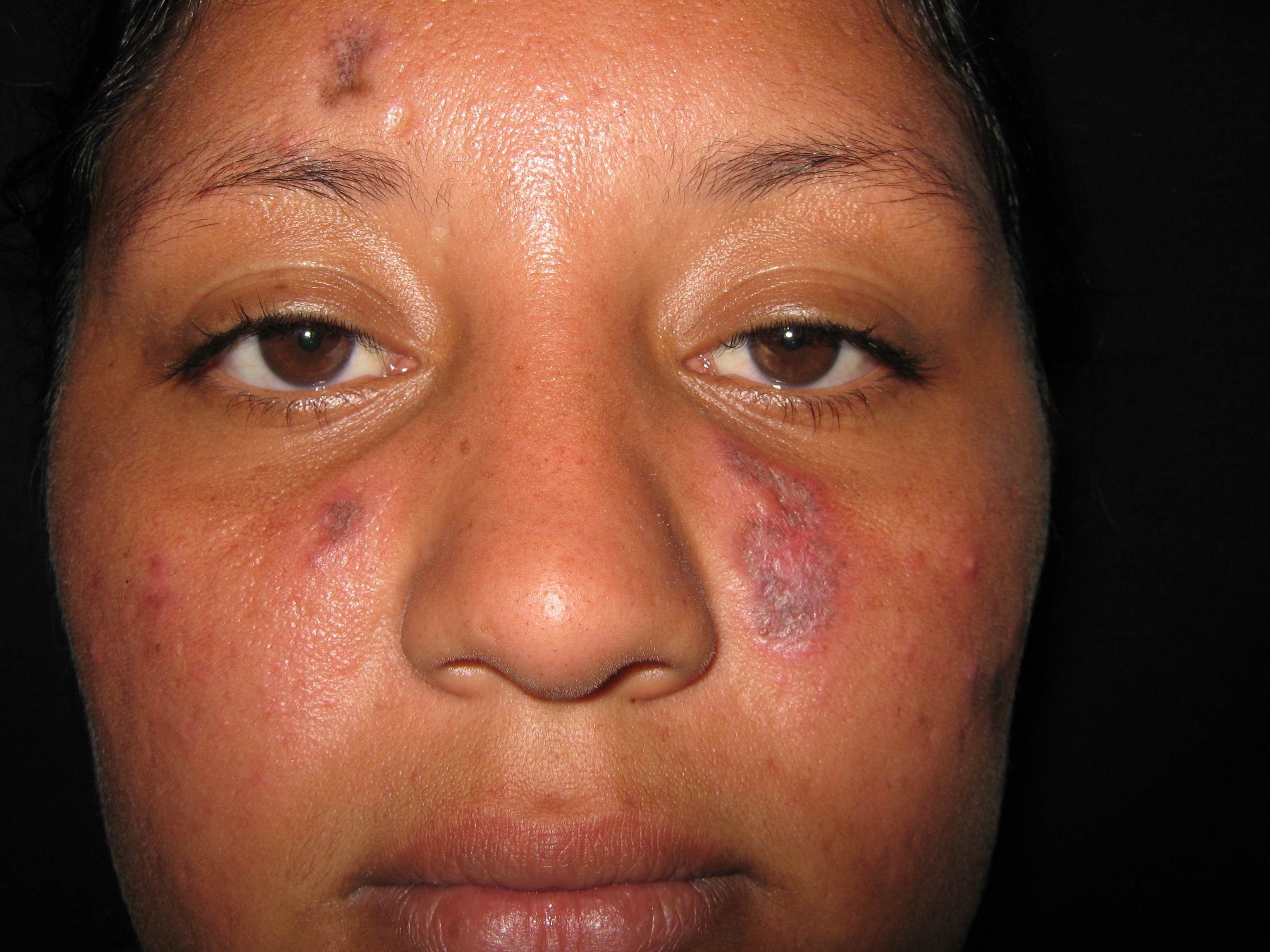 LUPUAS ERITEMATOSO DISCOIDE