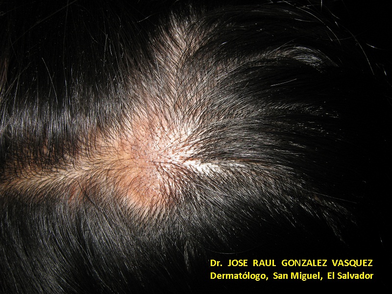 LUPUAS ERITEMATOSO DISCOIDE - Alopecia cicatrizal