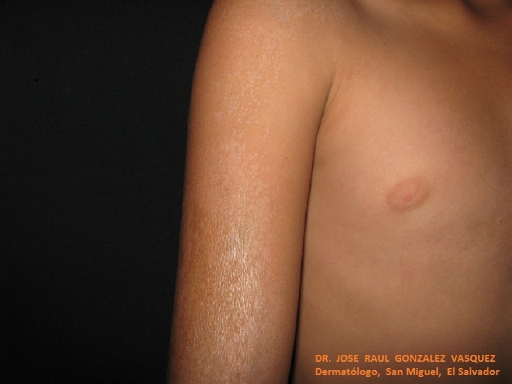 ESCLERODERMIA EN PLACAS