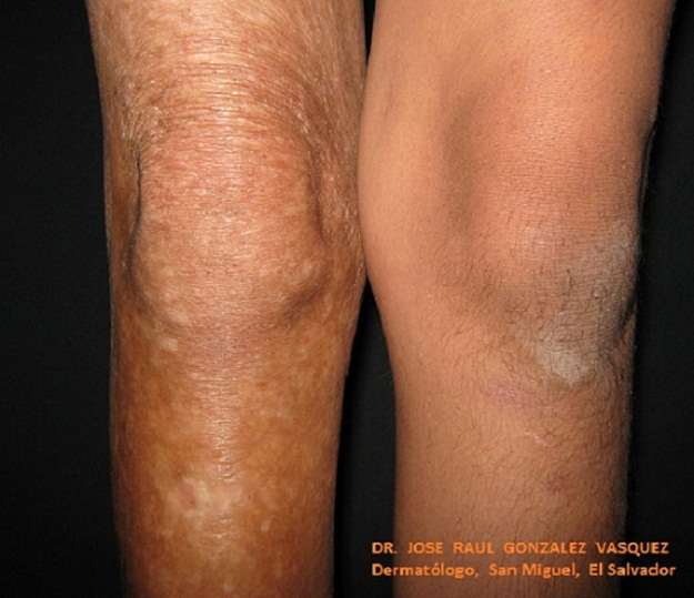 ESCLERODERMIA LINEAL