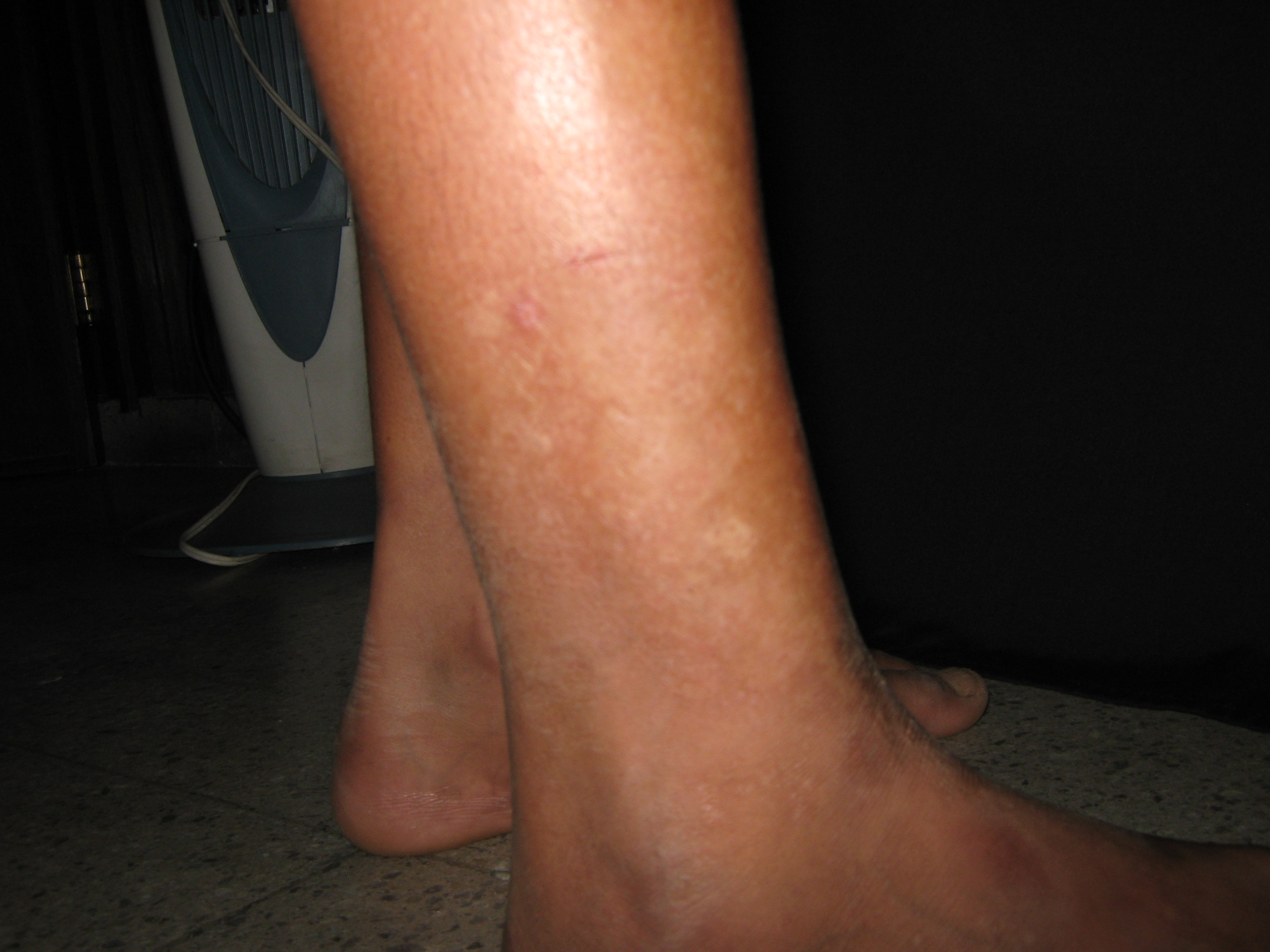 ESCLERODERMIA LINEAL