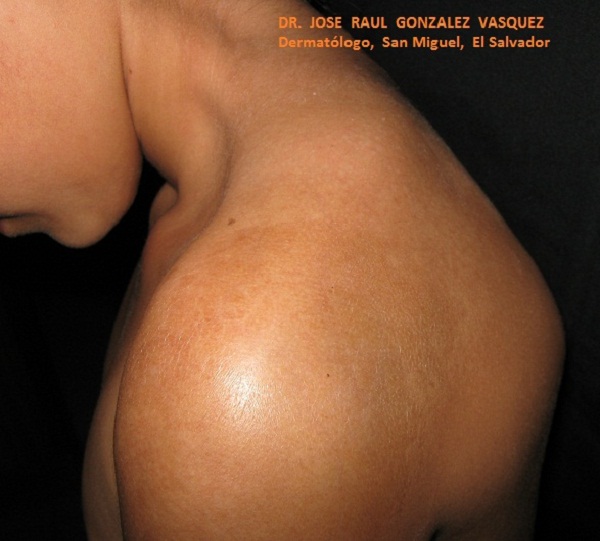 ESCLERODERMIA EN PLACAS