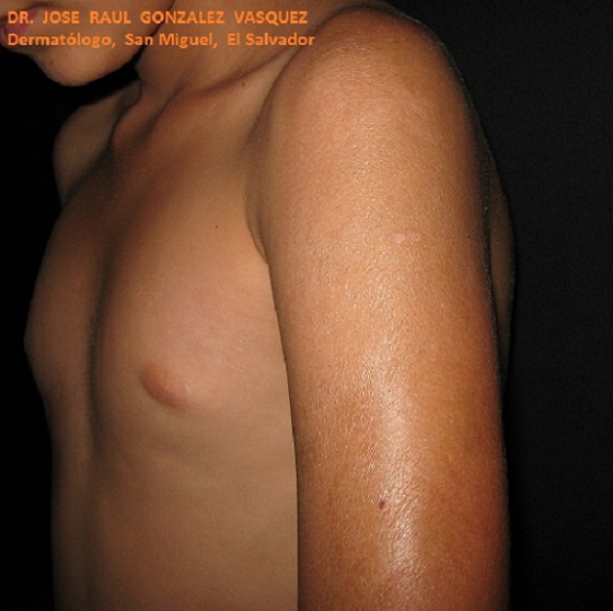 ESCLERODERMIA EN PLACAS