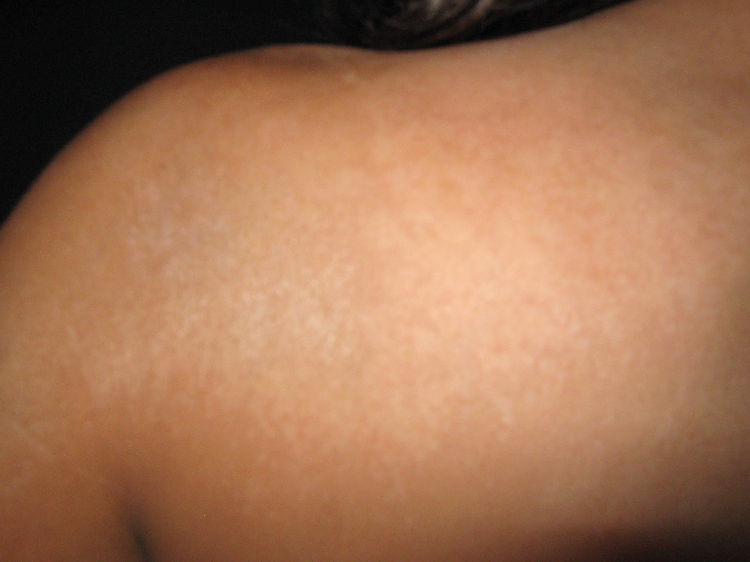 ESCLERODERMIA EN PLACAS