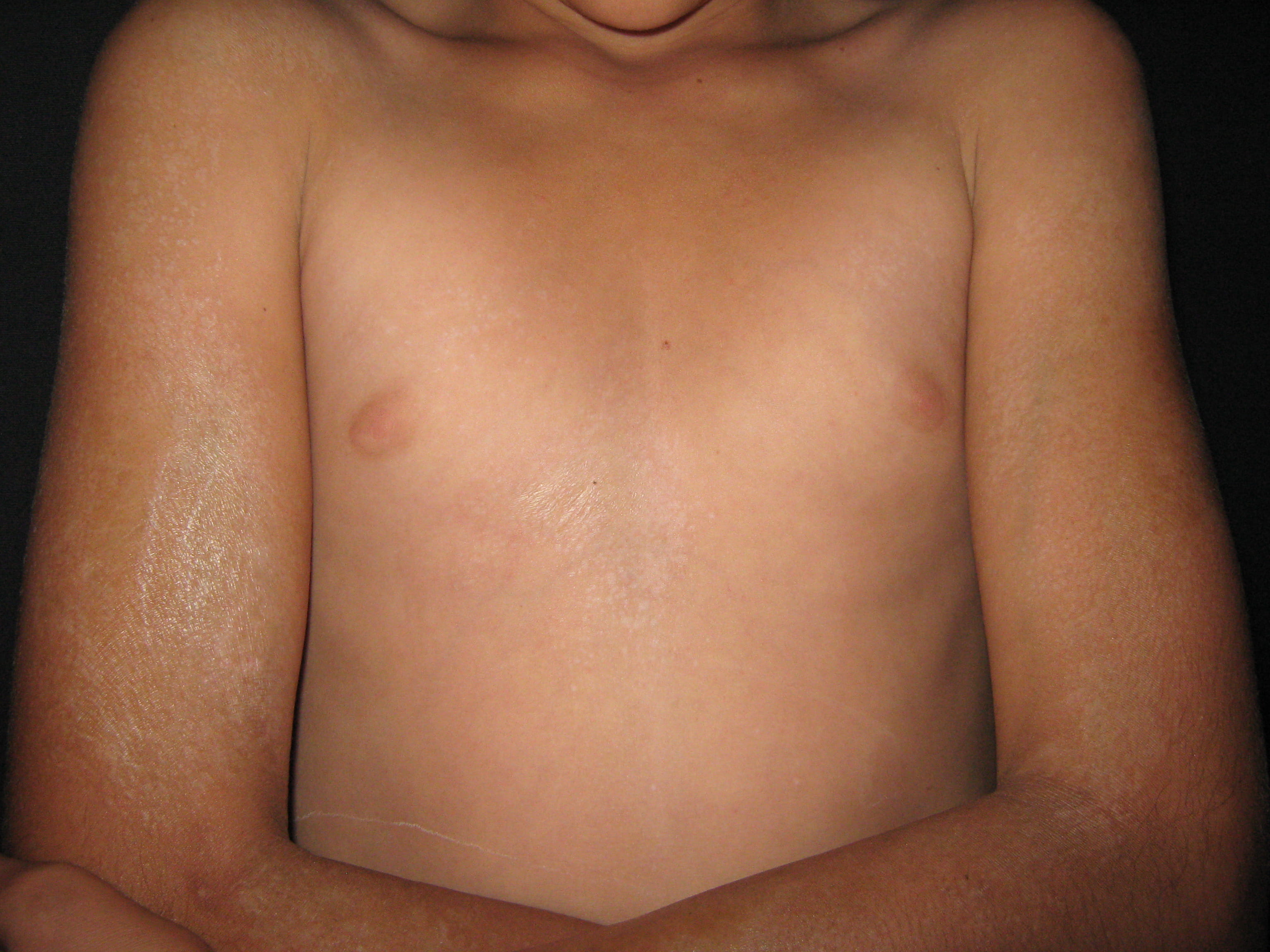 ESCLERODERMIA EN PLACAS