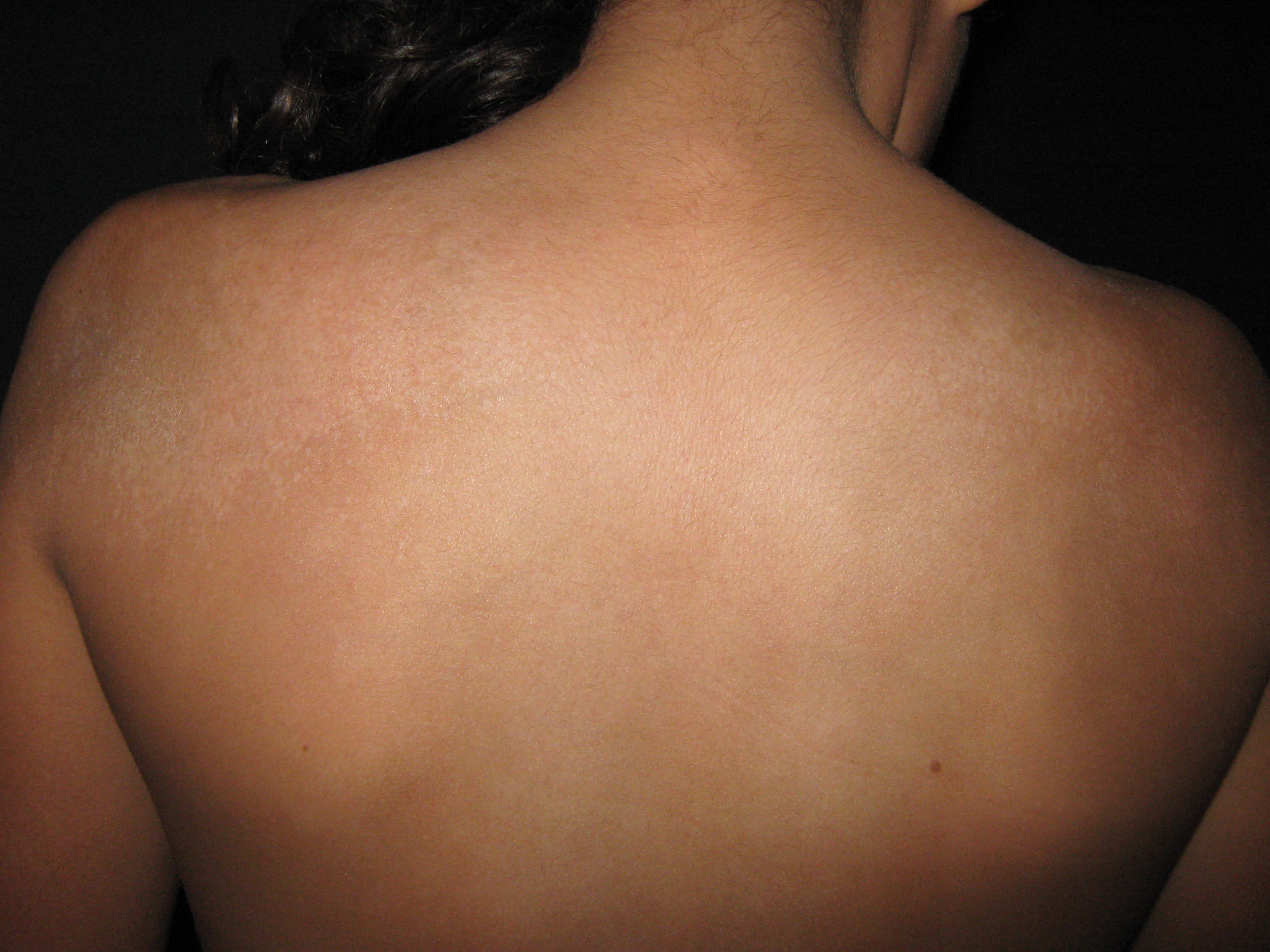 ESCLERODERMIA EN PLACAS