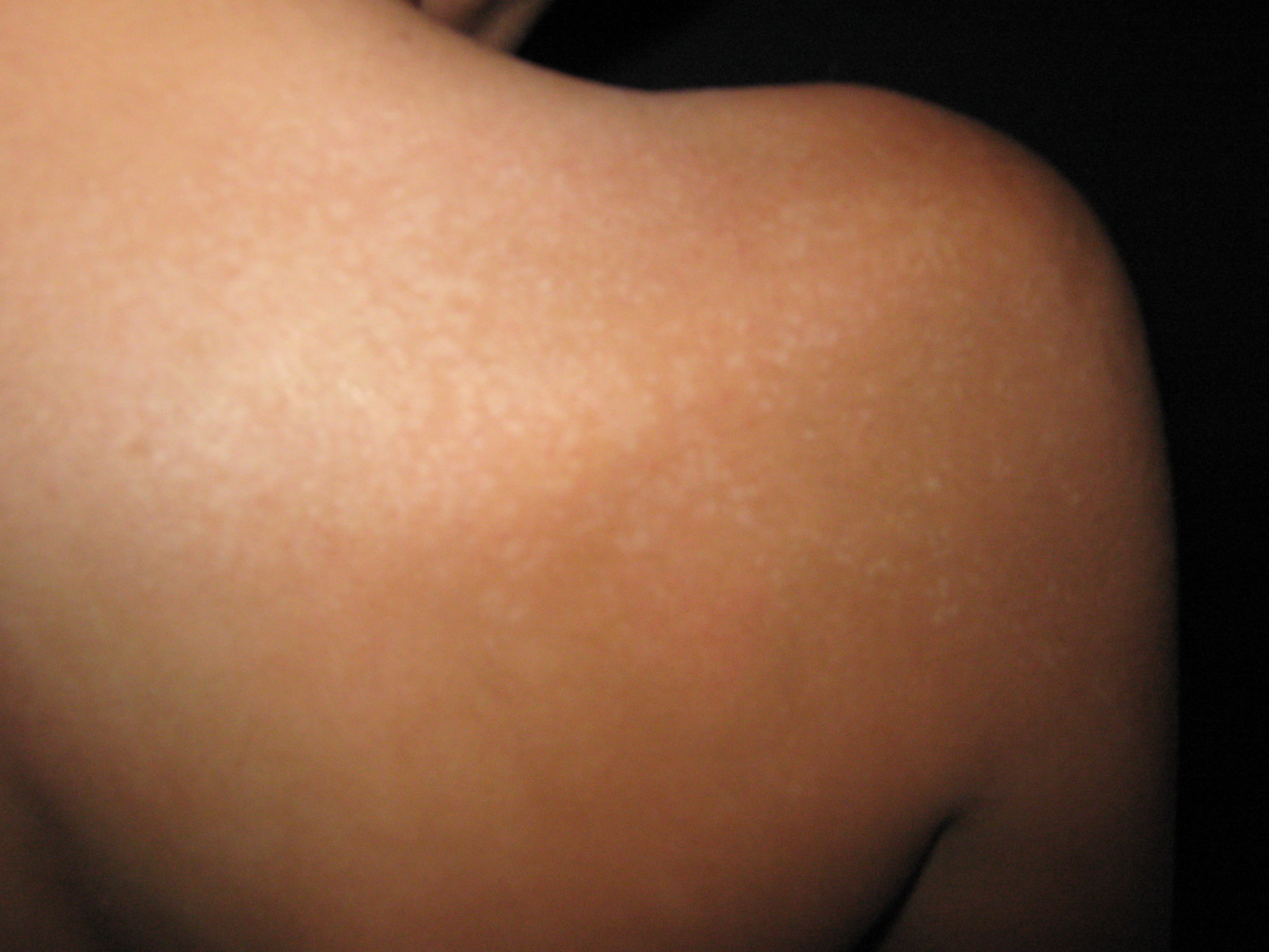 ESCLERODERMIA EN PLACAS