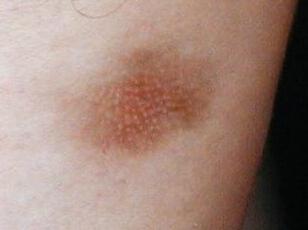 ESCLERODERMIA EN PLACAS