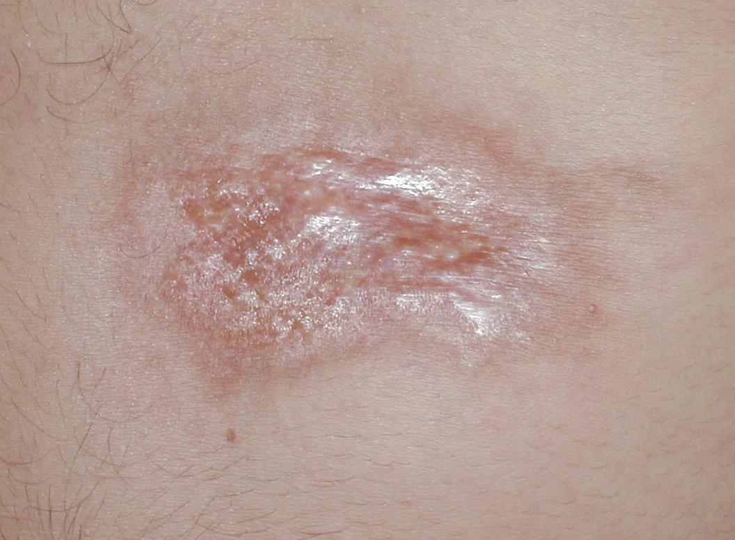 ESCLERODERMIA EN PLACAS