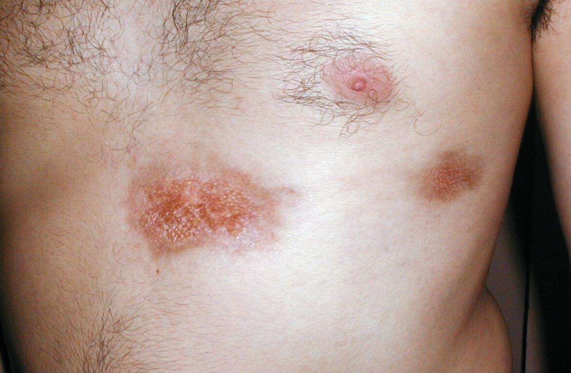 ESCLERODERMIA EN PLACAS