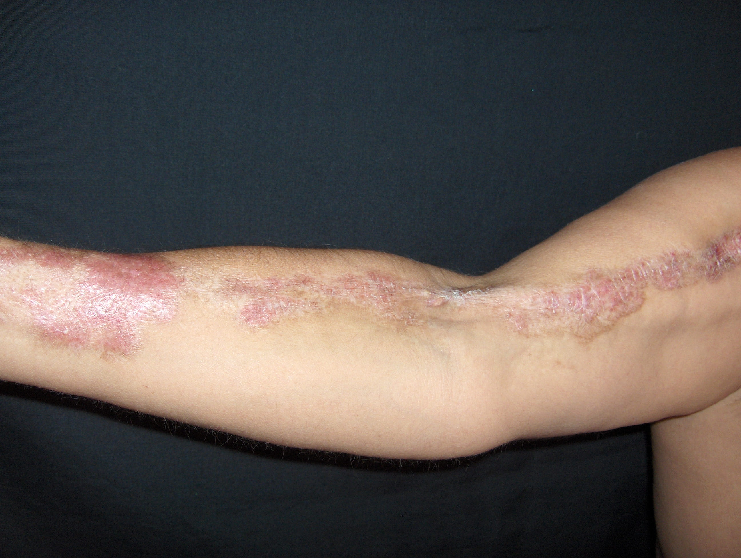 ESCLERODERMIA Profunda ó Panesclerótica