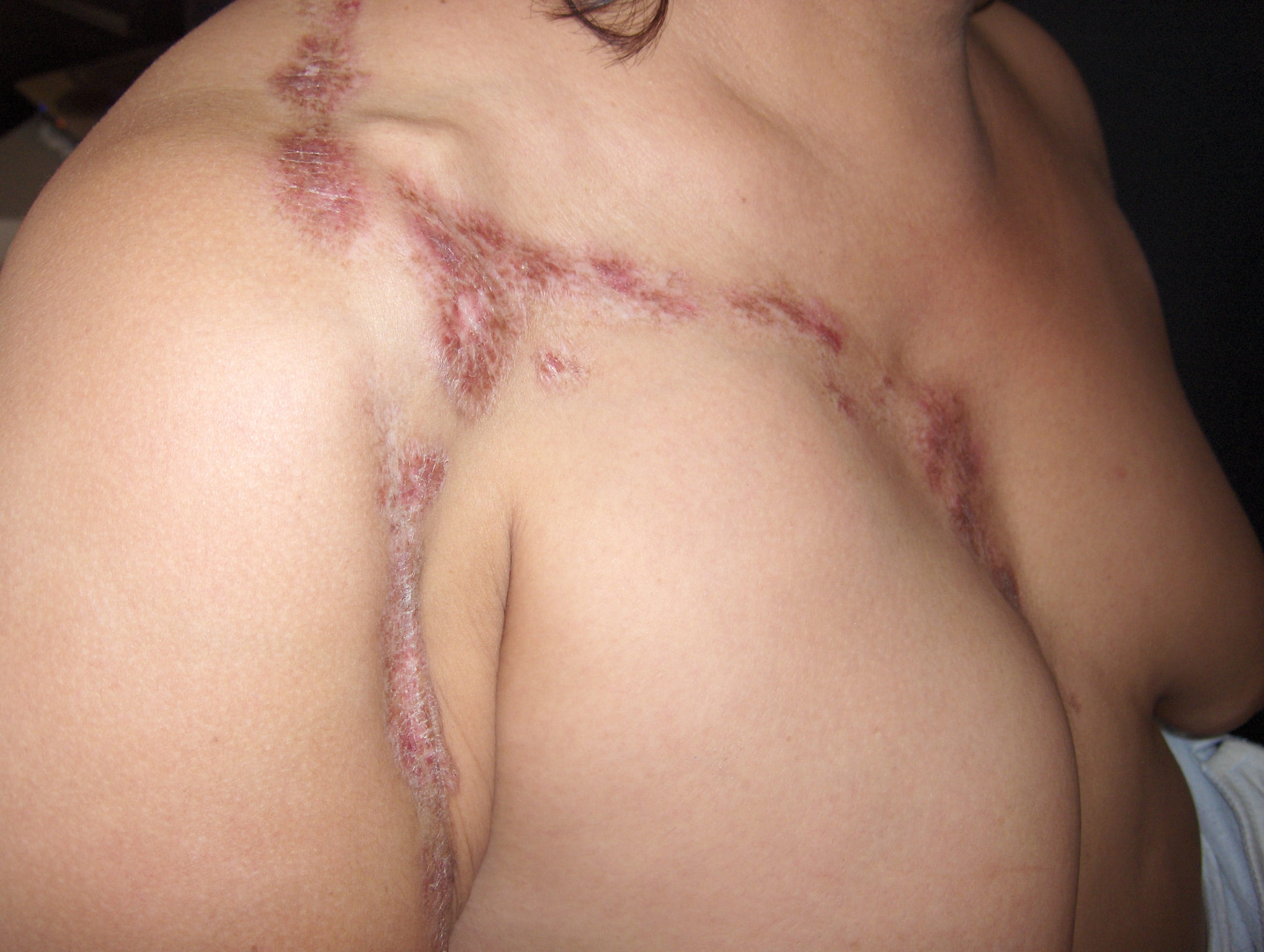 ESCLERODERMIA Profunda ó Panesclerótica