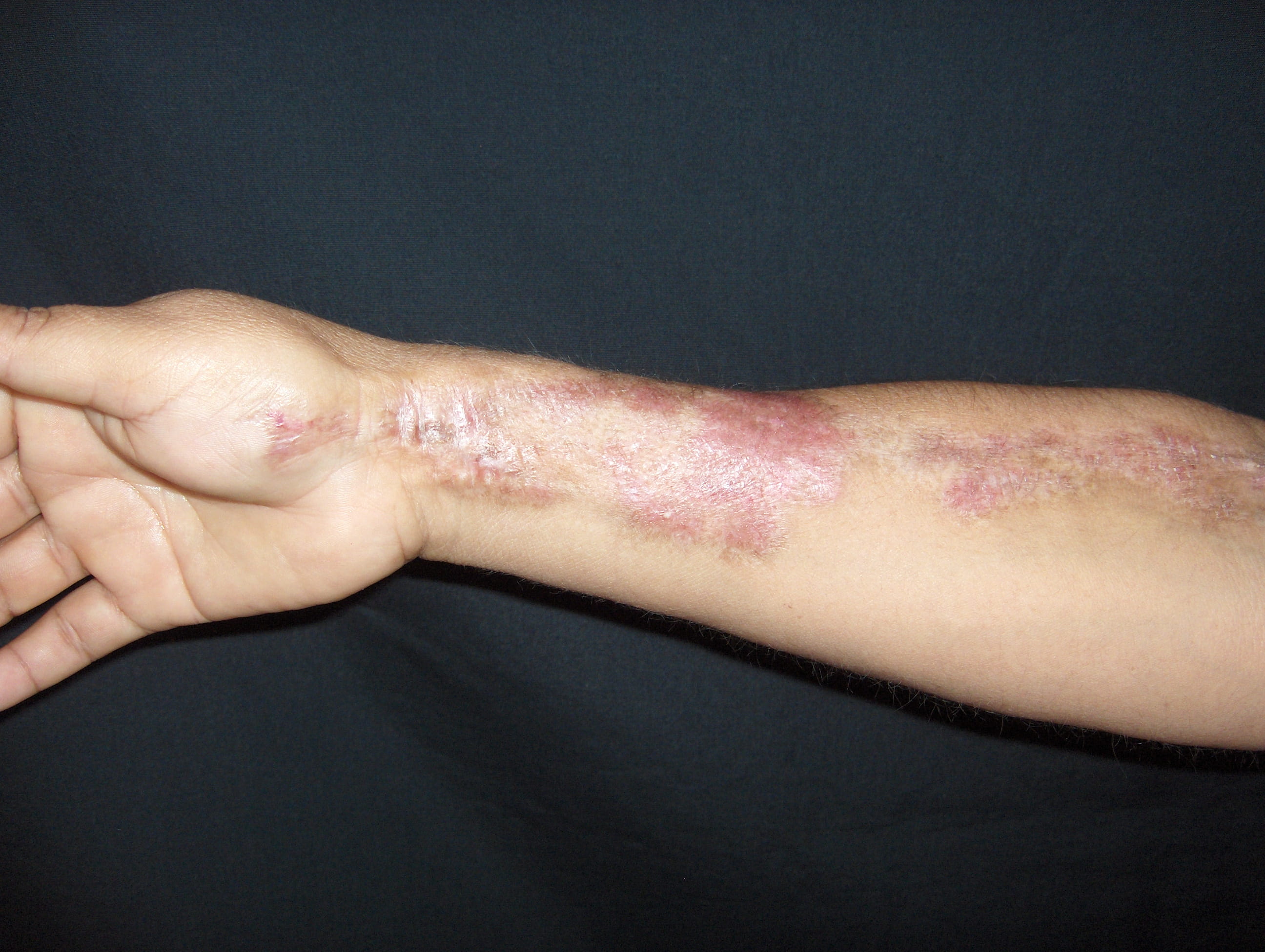 ESCLERODERMIA Profunda ó Panesclerótica