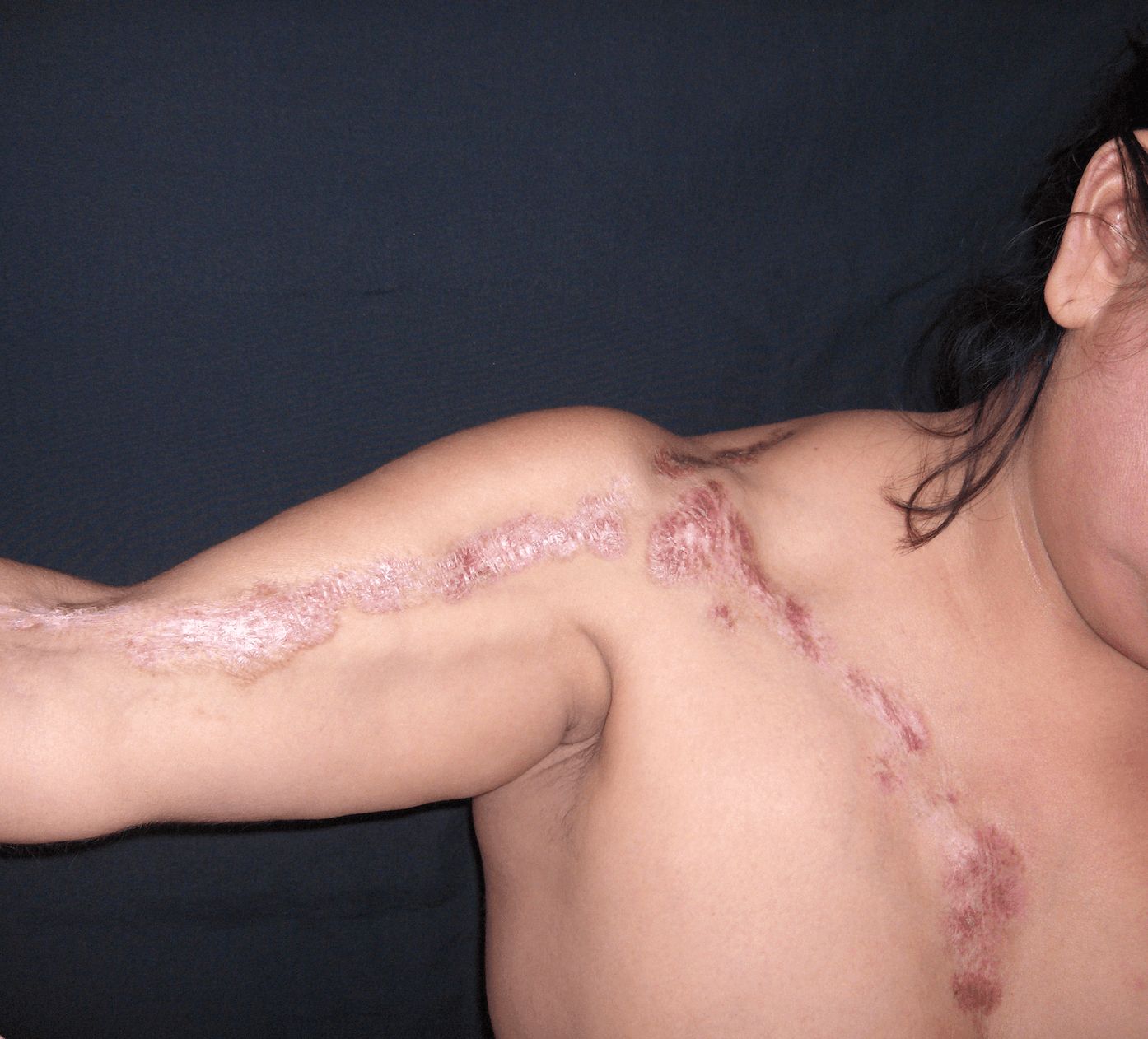 ESCLERODERMIA Profunda ó Panesclerótica