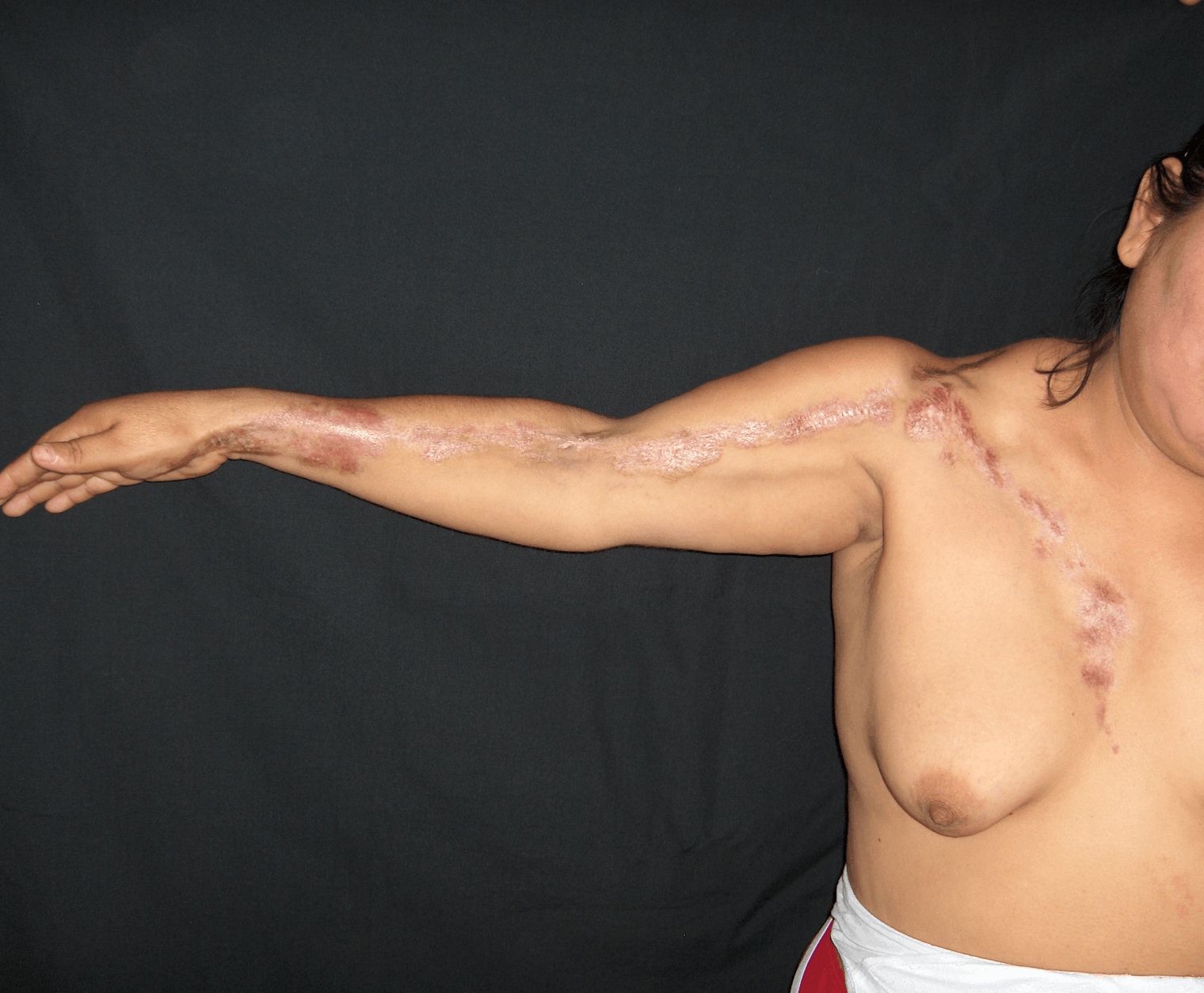 ESCLERODERMIA Profunda ó Panesclerótica