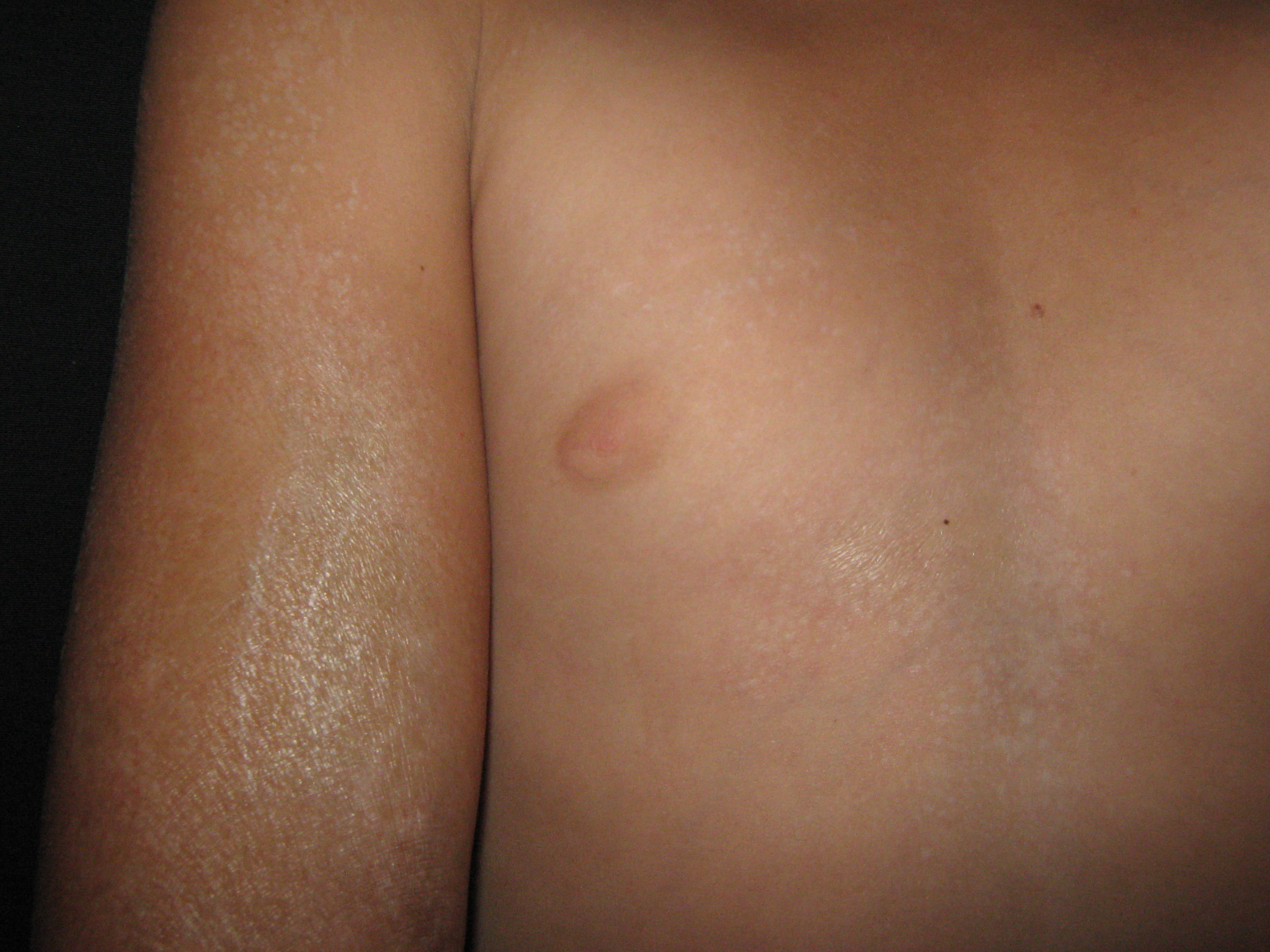 ESCLERODERMIA