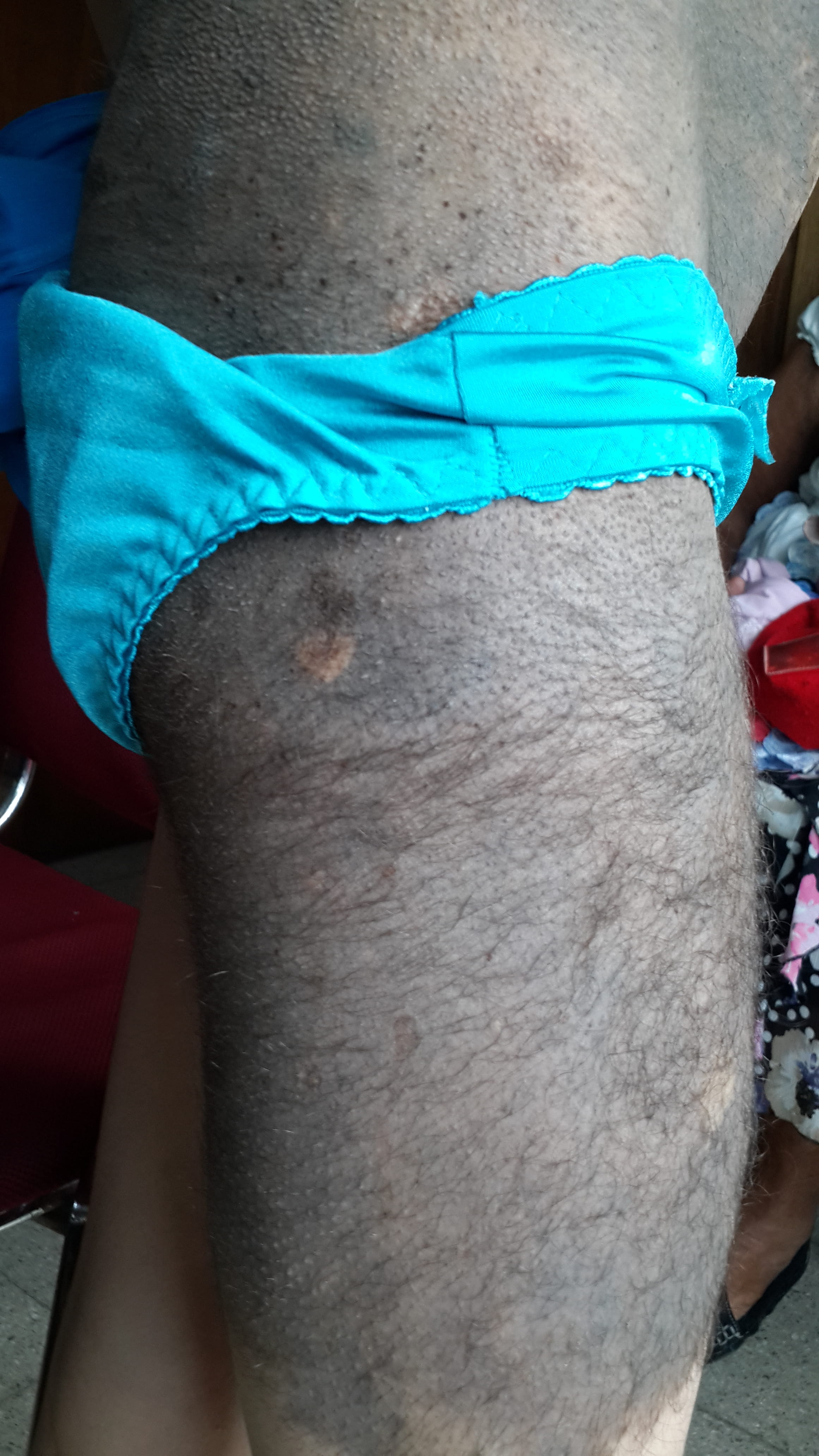 NEVO PIGMENTADO PILOSO Gigante