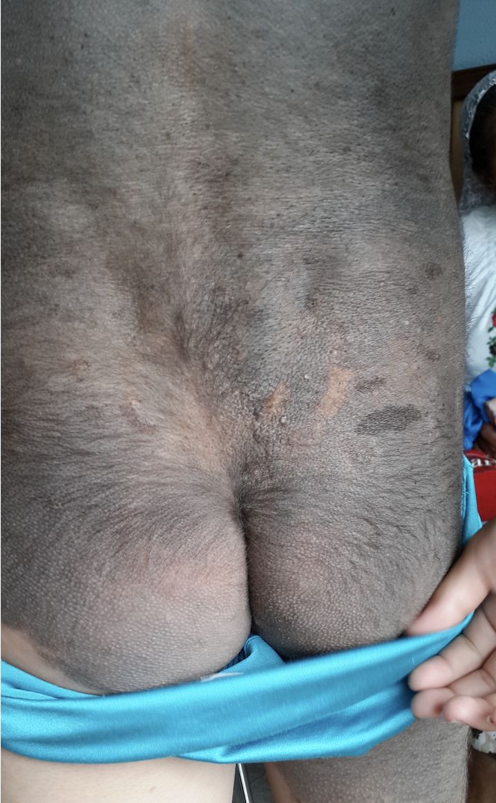 NEVO PIGMENTADO PILOSO Gigante