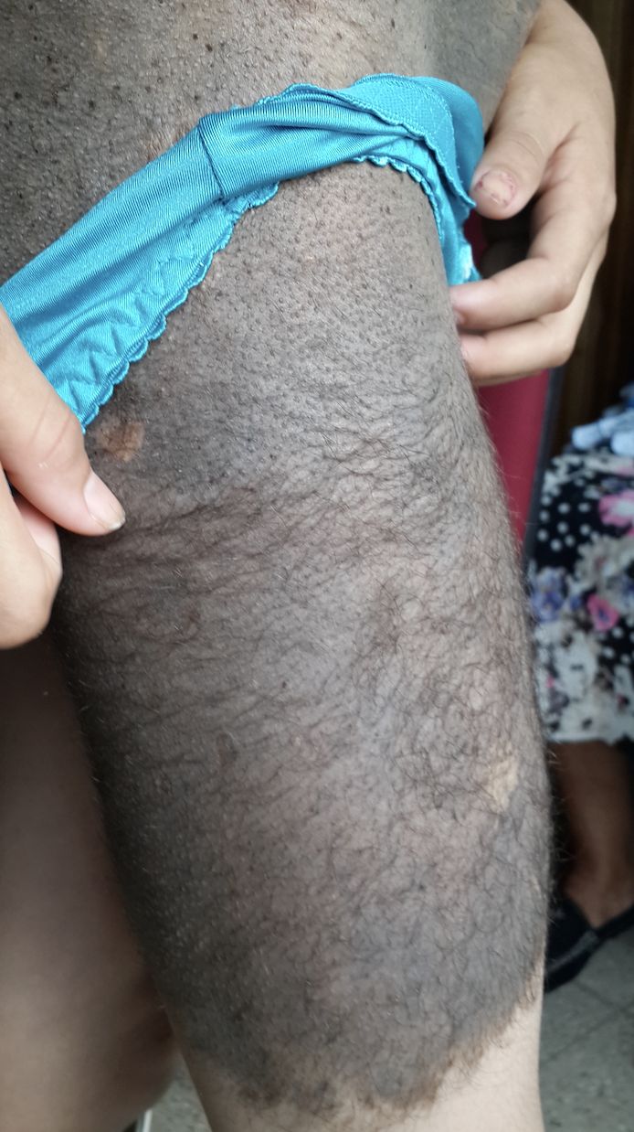 NEVO PIGMENTADO PILOSO Gigante