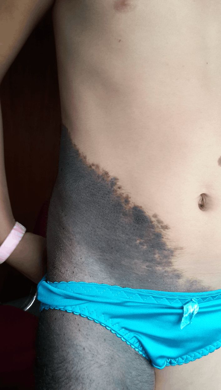 NEVO PIGMENTADO PILOSO Gigante