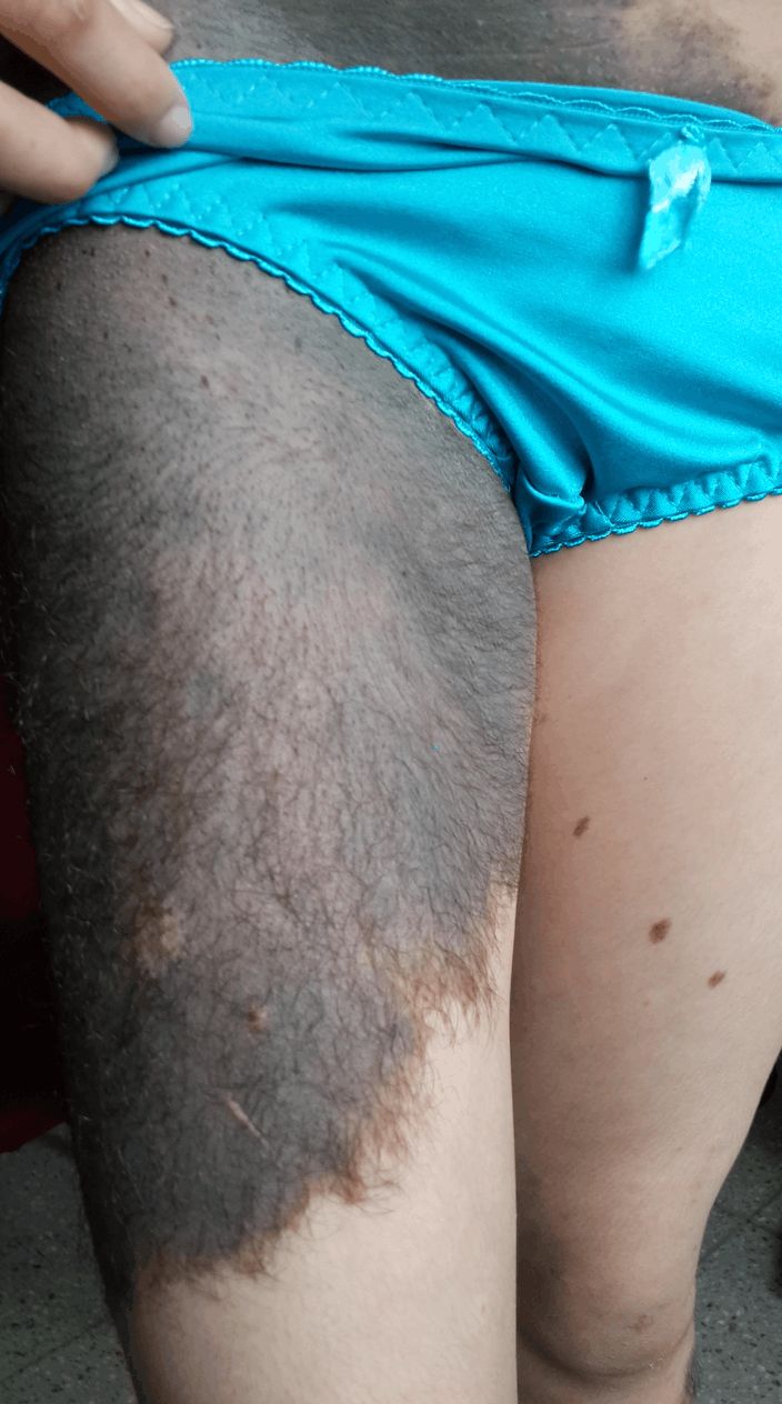 NEVO PIGMENTADO PILOSO Gigante