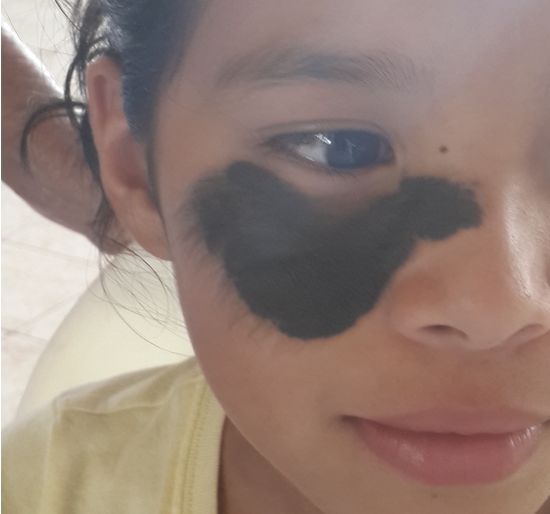 NEVO PIGMENTADO PILOSO Gigante