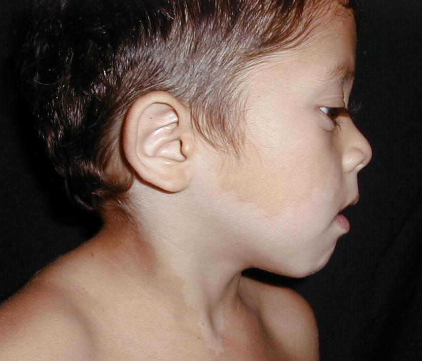 NEVO ACROMICO