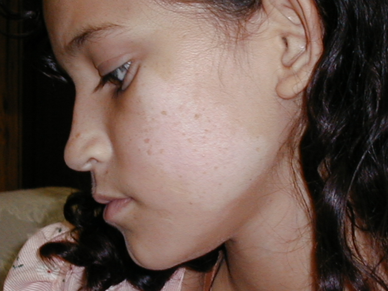 NEVO ACROMICO