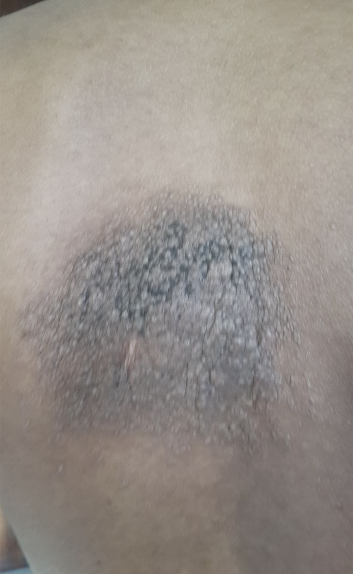 NEVO EPIDERMICO