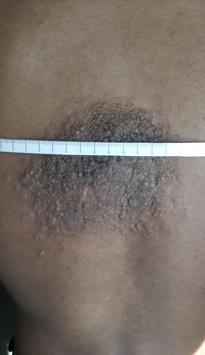 NEVO EPIDERMICO