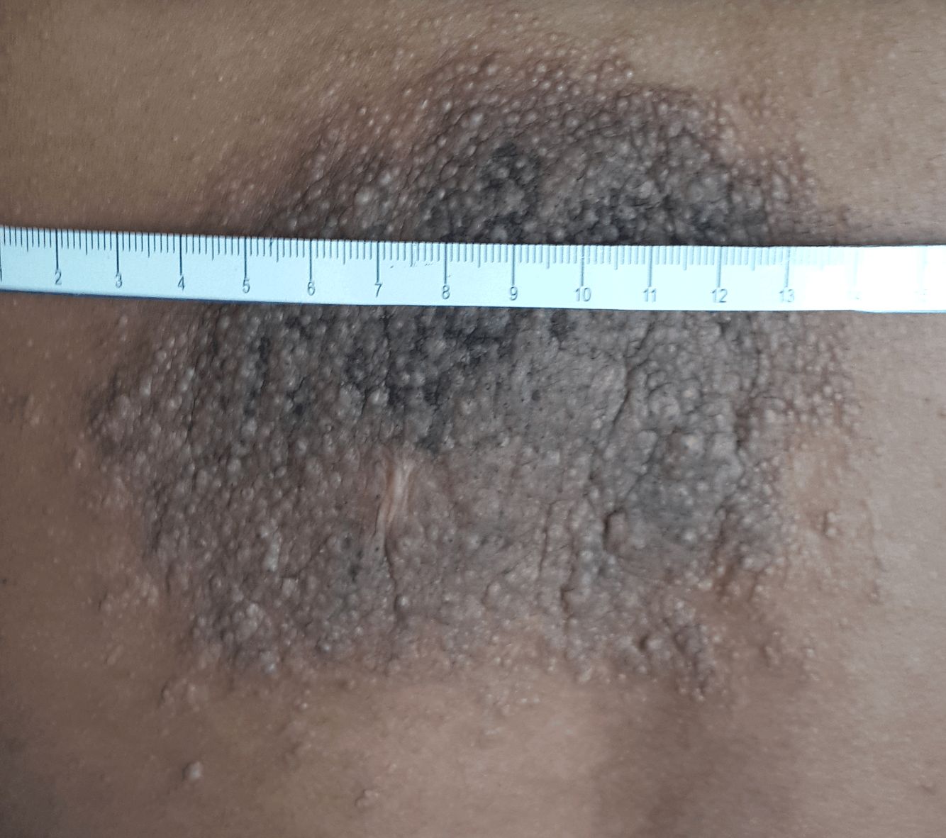 NEVO EPIDERMICO