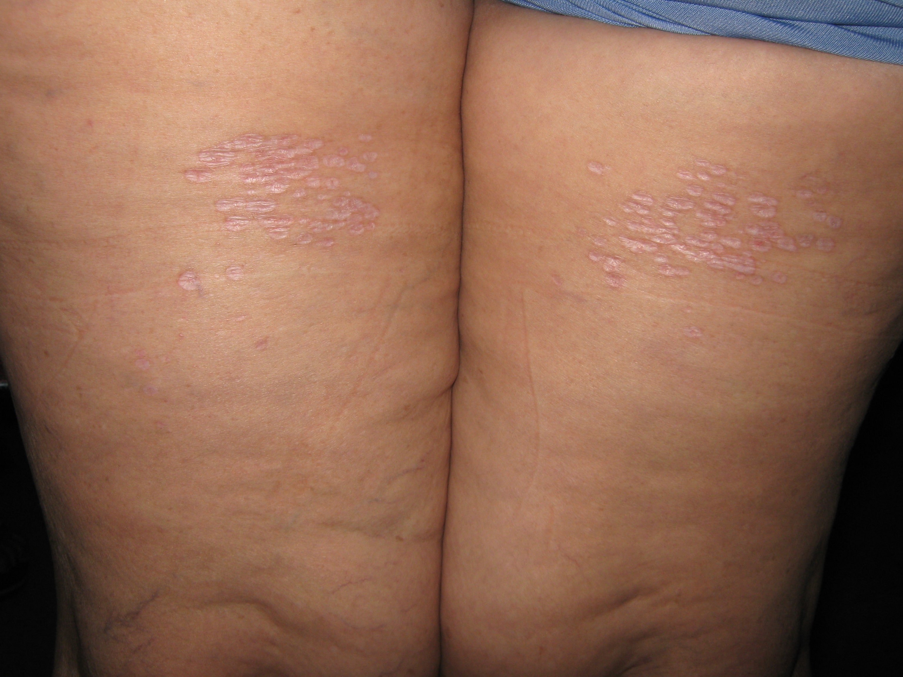 LIQUEN ESCLEROSO Y ATROFICO