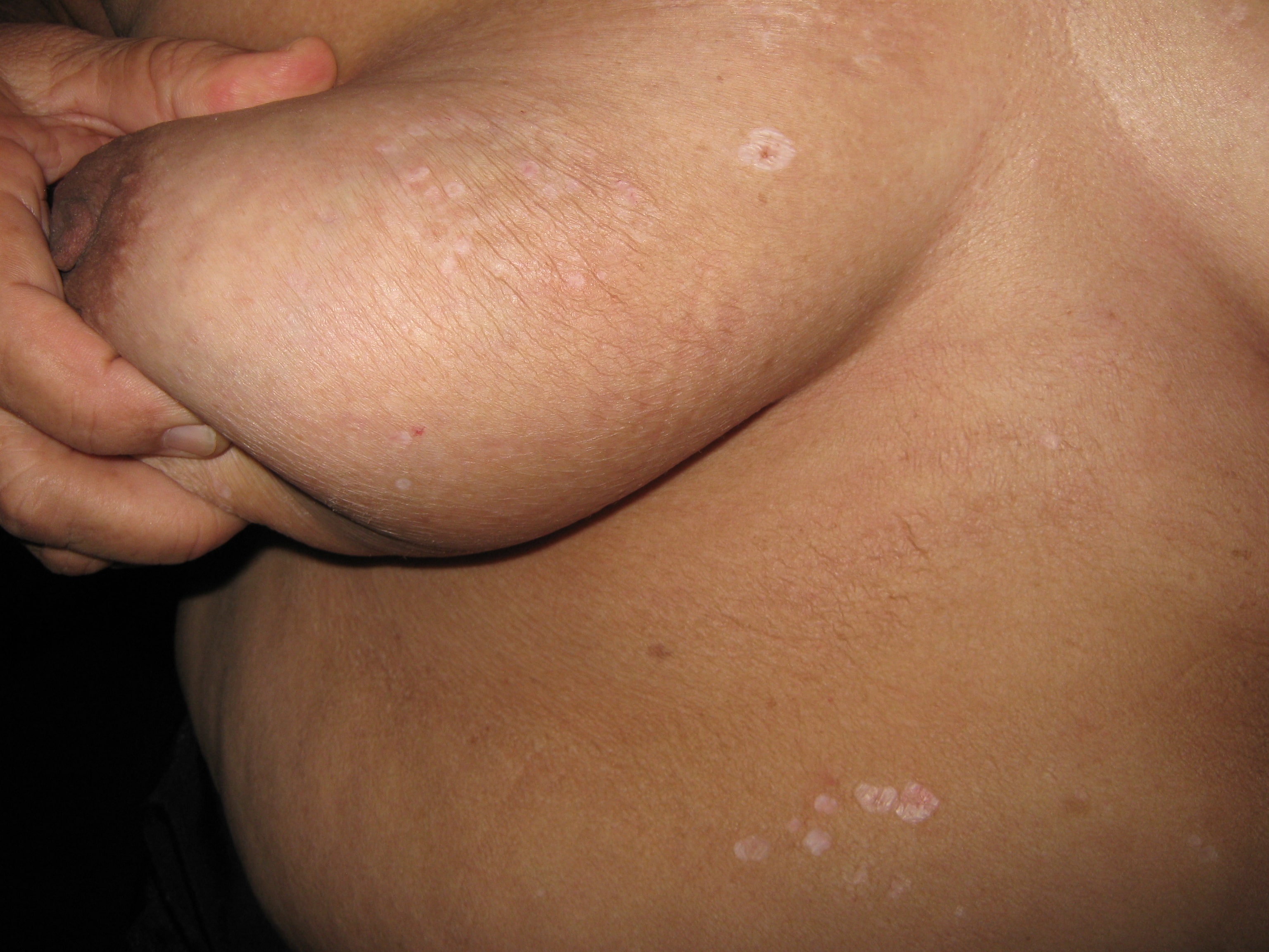 LIQUEN ESCLEROSO Y ATROFICO