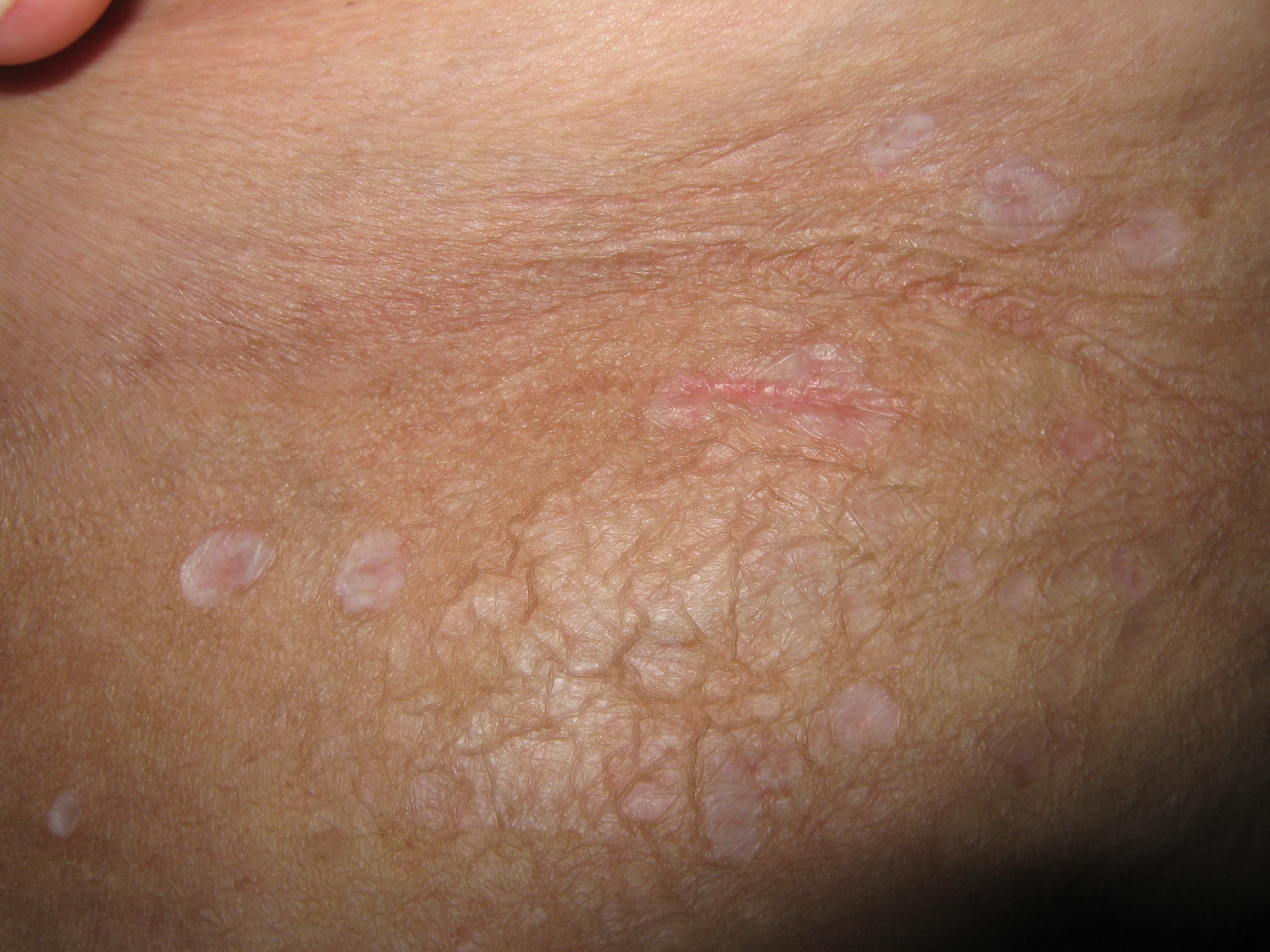 LIQUEN ESCLEROSO Y ATROFICO