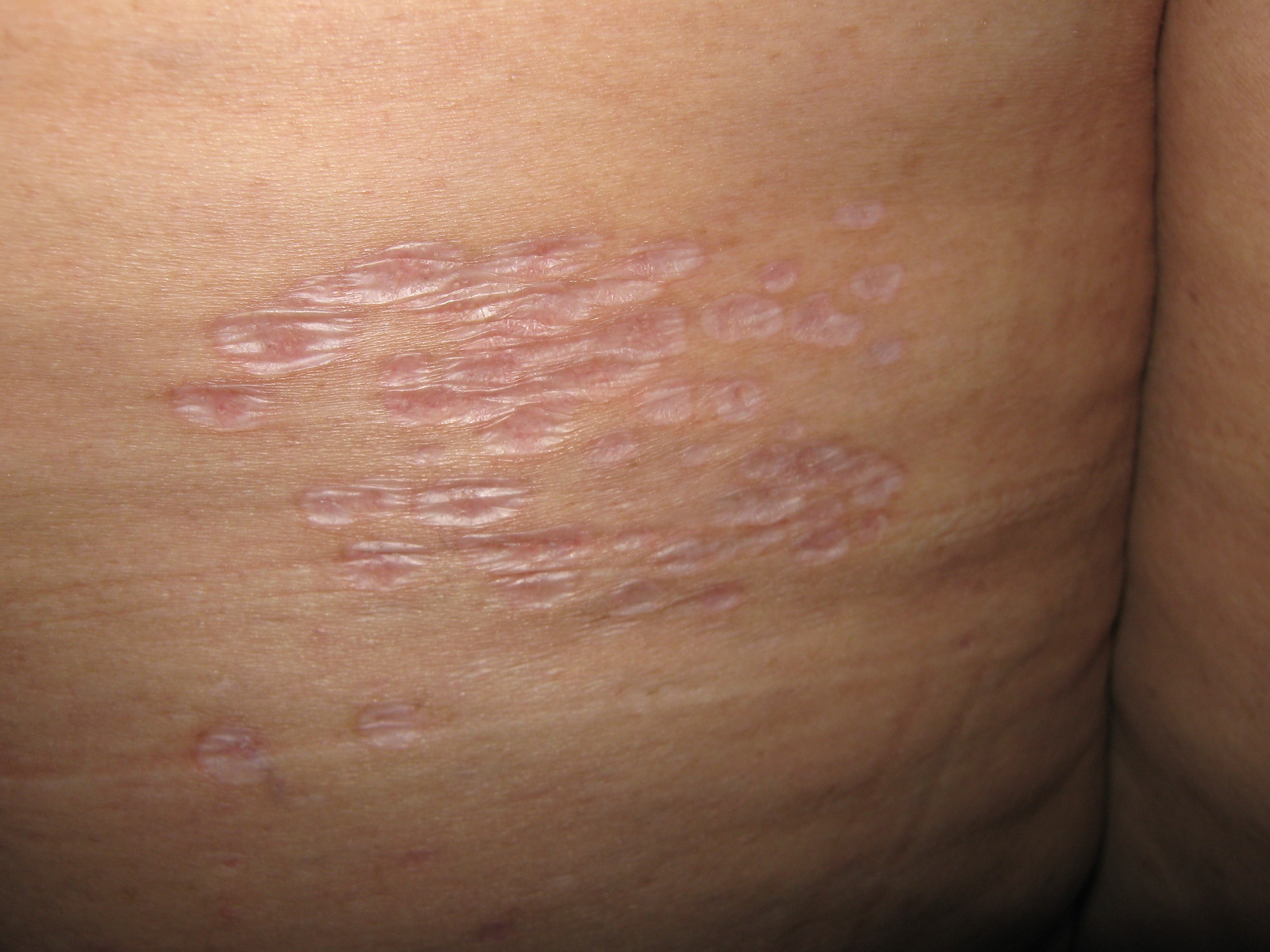 LIQUEN ESCLEROSO Y ATROFICO