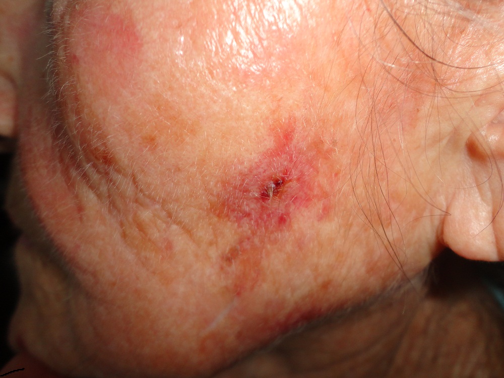 QIUERATOSIS ACTINICA