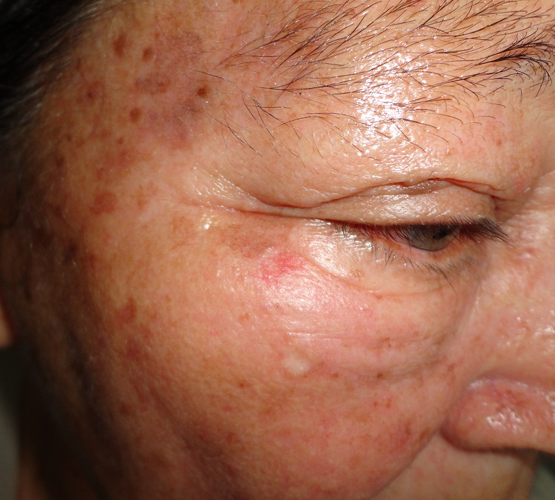 QIUERATOSIS ACTINICA