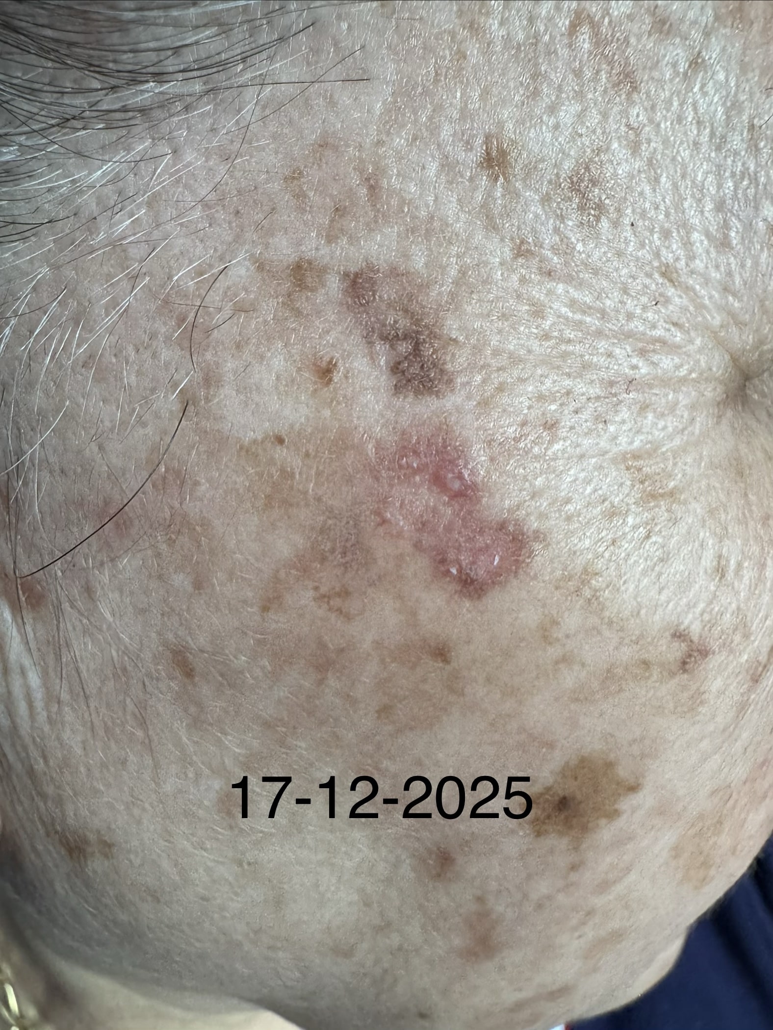 QIUERATOSIS ACTINICA